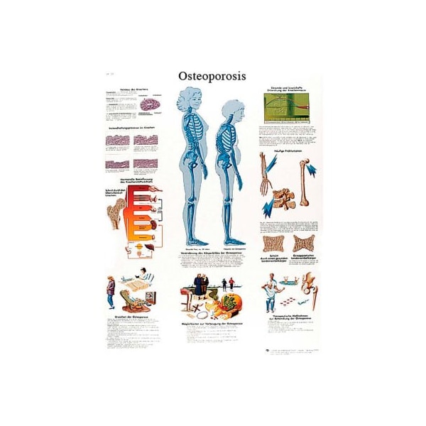 3B Anatomical Chart - Osteoporosis, Paper
